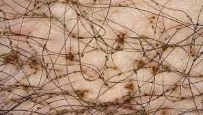 Радикално решение на деликатен проблем: ефективни начини да се отървете от пубисната педикулоза